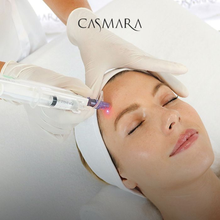 Woman receiving a facial laser treatment on the forehead, with a clinician wearing gloves and Casmara logo visible above.